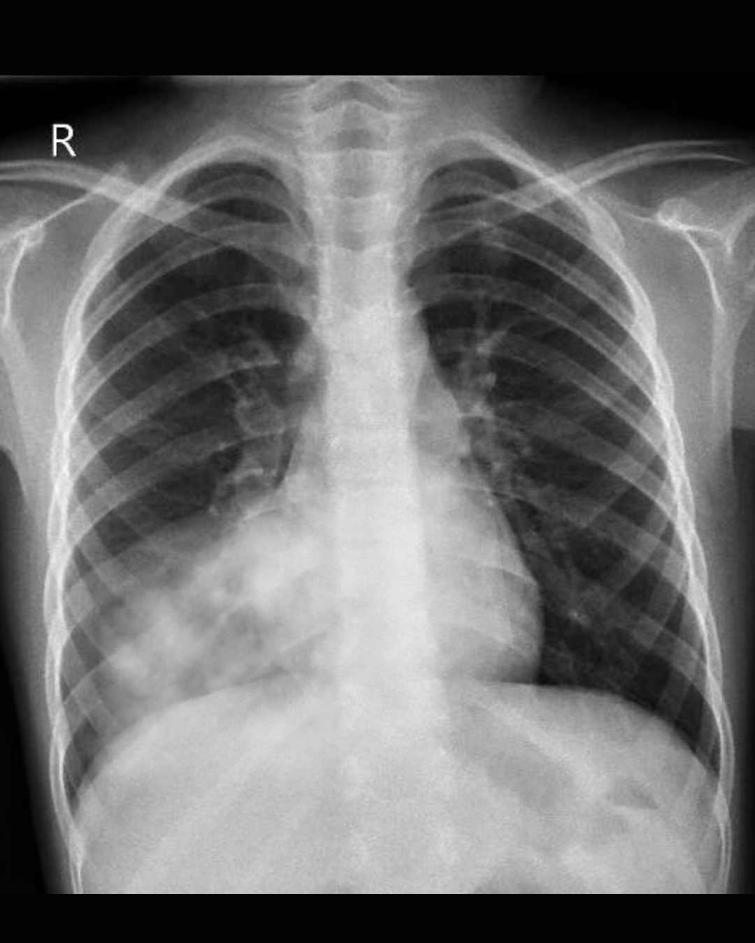 Radiografía de tórax de niño de 12 años con infiltrado basal derecho característico de neumonía en niños.